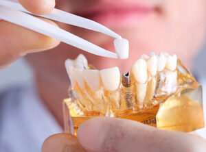 Implante Dentário em Campinas
