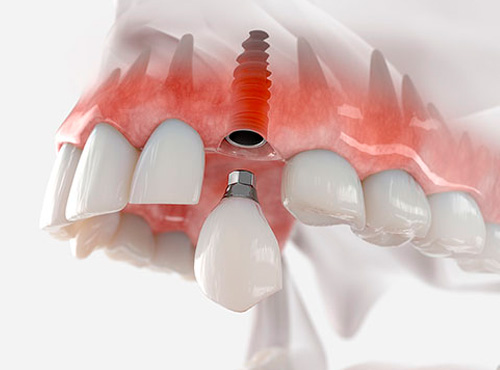 Clínica de Implantes Dentários Campinas SP
