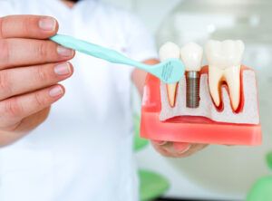 Conservar o Implante Dentário Campinas