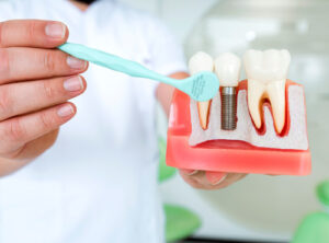 Implante Dentário Campinas