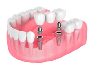 Implante Dentário Campinas SP