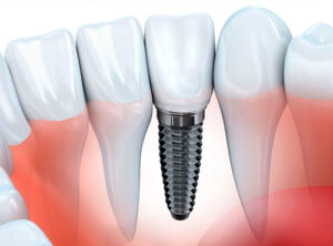 Implantes imediatos