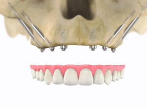 Implantes Zigomáticos