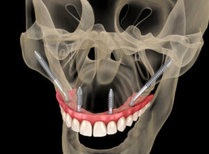 Implantes Zigomáticos Campinas