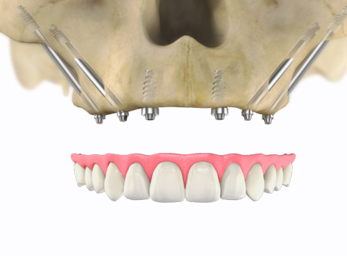 Implantes Zigomáticos