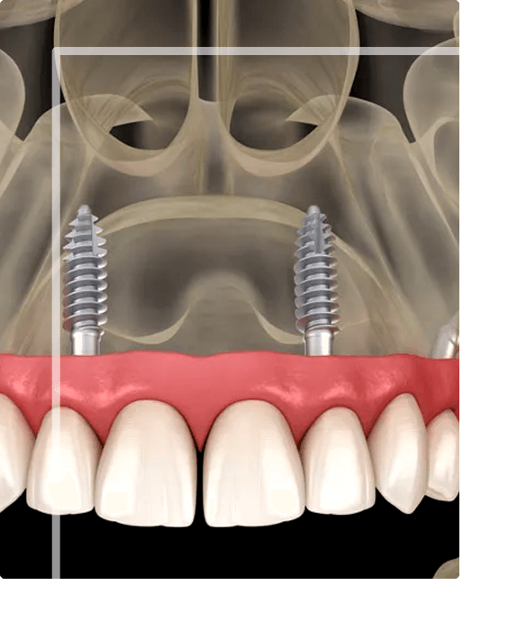 Implantes Zigomáticos Campinas SP