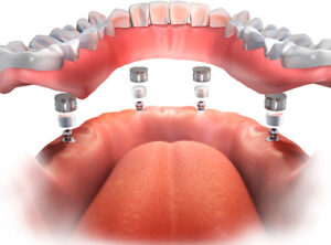 Protocolo sobre implantes Campinas