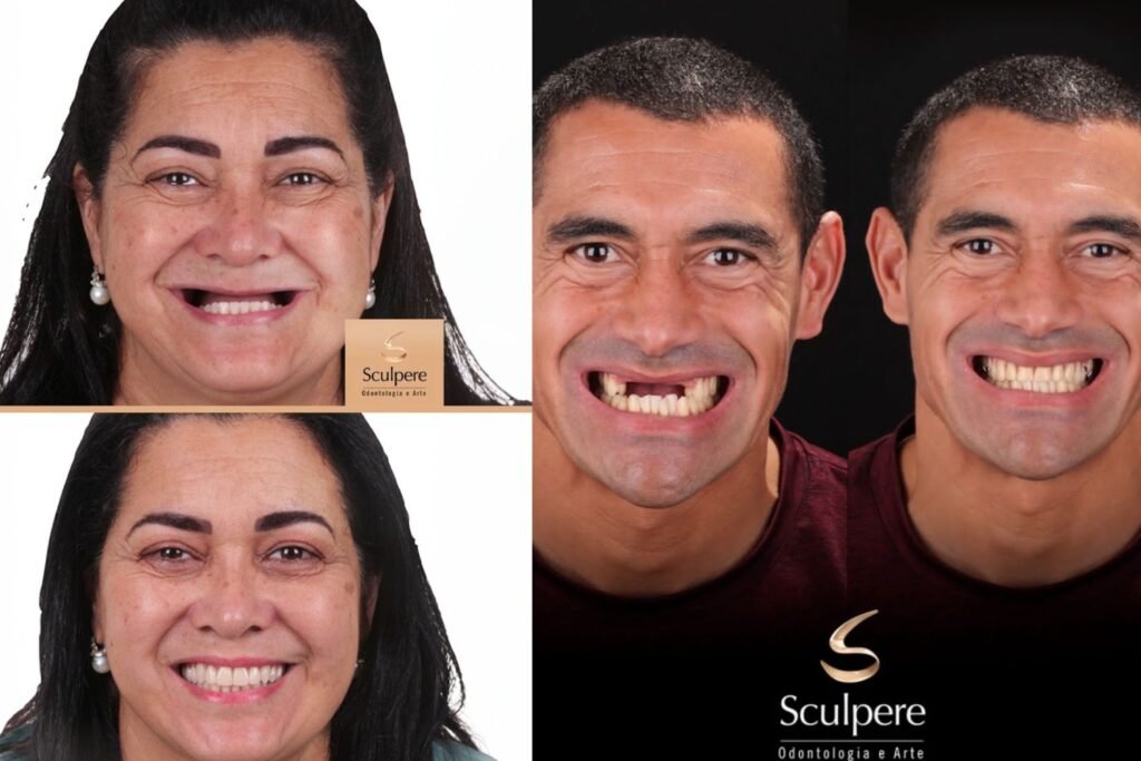 prótese protocolo antes e depois